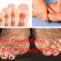 Какие симптомы артрита пальцев ног?