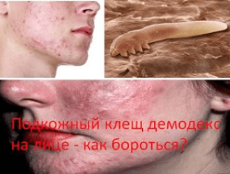 Подкожный клещ демодекс на лице — как бороться?