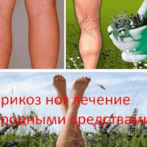 Варикоз ног лечение народными средствами