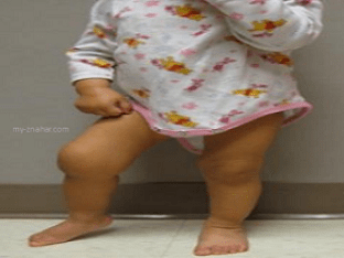 Как лечить артрит коленного сустава у детей?
