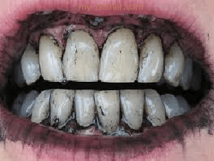 Чем можно отбелить зубы в домашних условиях?