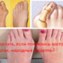 Что делать, если появились косточки на ногах, народные рецепты?