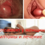 Бартолинит у женщин симптомы и лечение