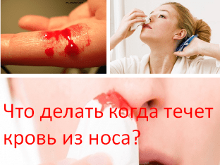 Что делать, когда течет кровь из носа?