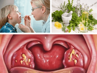 Что делать при боле в горле, средства от тонзиллита и простуды?