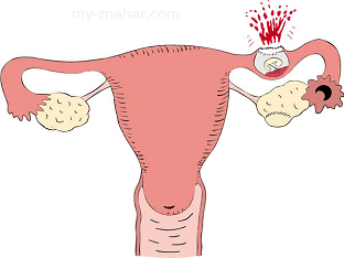 Что из себя представляет внематочная беременность?