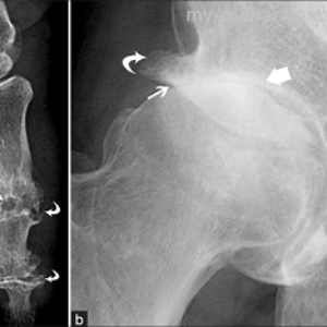 Склероз суставов. Подхрящевой субхондральный склероз. Остеосклероз бедренной рентген. Субхондральный склероз l2. Остеосклероз тазобедренного сустава рентген.