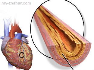 Что значит ишемическая болезнь сердца?