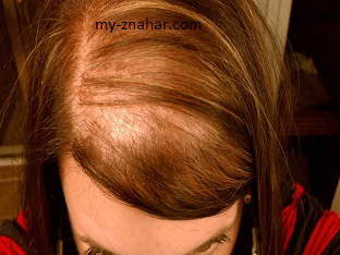Диффузная алопеция у женщин, причины выпадения волос