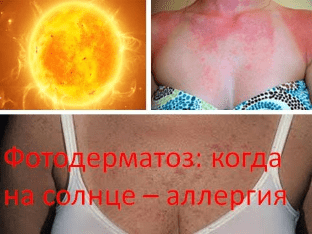 Фотодерматоз: когда на солнце – аллергия