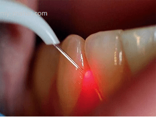 Как избавиться от зубного камня при помощи ультразвука?