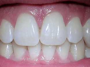 Как осуществляется профилактика зубного камня?