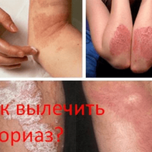 Как вылечить псориаз?