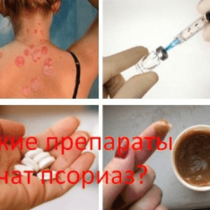 Какие препараты лечат псориаз?