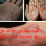 Ладонно-подошвенный псориаз – основные признаки