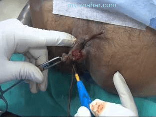 Операция по удалению (иссечению) анальной трещины