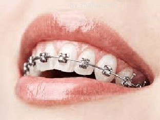 Ортодонтия (брекет-системы): эффективный путь к красивой и здоровой улыбке