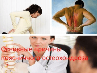 Основные причины поясничного остеохондроза