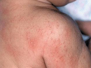 Причины высыпаний на коже при дисбактериозе