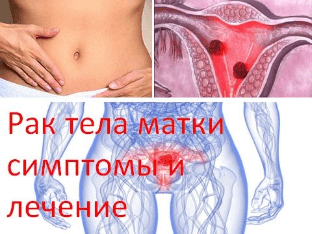 Рак тела матки симптомы и лечение