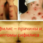 Сифилис – причины и симптомы сифилиса