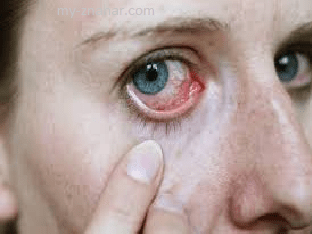 Симптомы глазных болезней учеловека