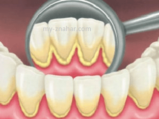 Зубной камень: что это такое и как его убрать