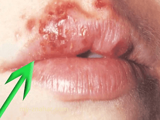 Чем лечить герпес на губах