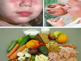 Что можно есть при аллергическом дерматите