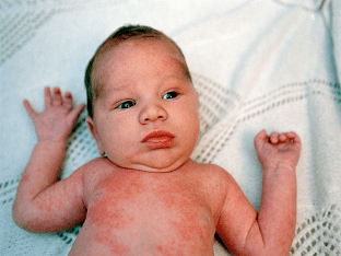 Как проявляется краснуха у грудничка и новорожденного