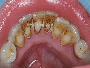 Как удалить зубной камень в стоматологии