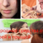 Народные средства от угрей и прыщей