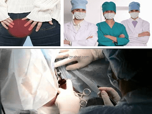 Операция по иссечению анальной трещины прямой кишки