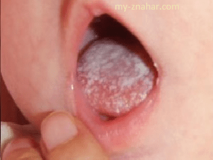 Почему во рту появляется стоматит