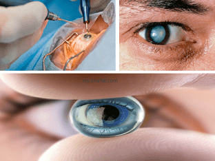 Замена хрусталика при катаракте, как делают операцию