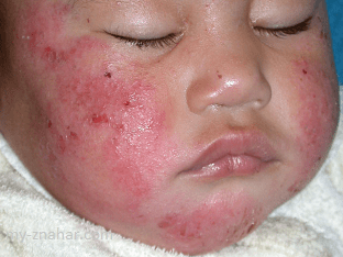 Что делать при аллергическом дерматите на лице