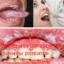 Дисбактериоз ротовой полости — причины развития