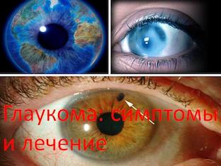 Глаукома: симптомы и лечение