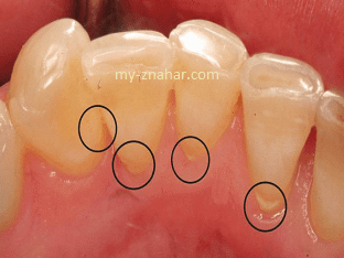 Как удалить зубной камень народными средствами