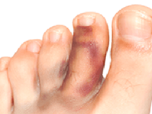 Как вылечить сломанный палец ноги