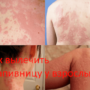 Лечение крапивницы у взрослых