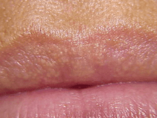Почему на губах под кожей появляются белые точки