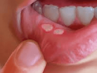 Почему появляется белые язвочки во рту, как их лечить