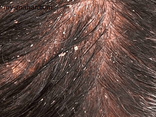 Себорейный дерматит кожи головы, что делать