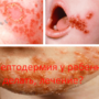Стрептодермия у ребенка, что делать, лечение?