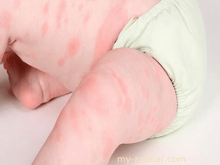 Что делать, если у ребенка аллергия, чем лечить