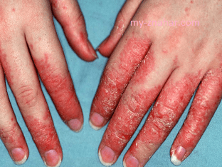 Что такое дерматит