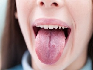 Что такое кандидоз слизистой полости рта, виды кандидоза
