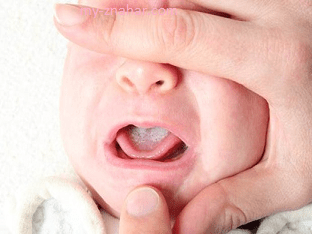 Как лечить кандидоз(молочницу) во рту у ребенка