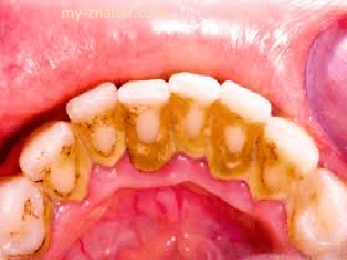 Каковы причины образования зубного камня